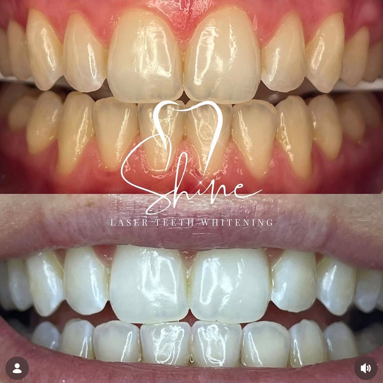Before and after teeth whitening result